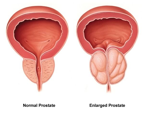 Prostate