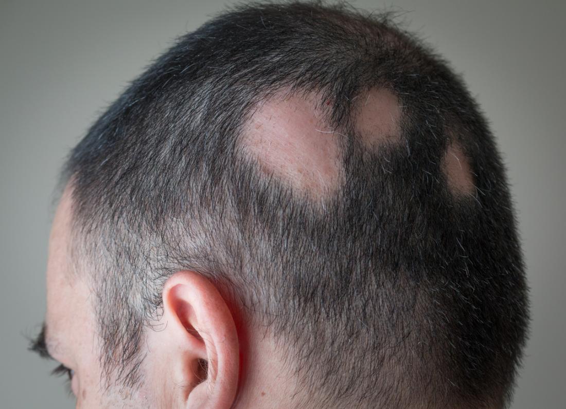 partial-alopecia